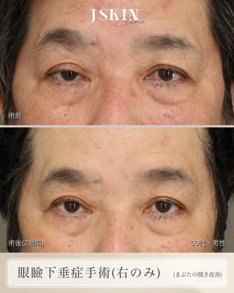 【症例】60代男性 眼瞼下垂（右・挙筋腱膜前転術）— 片目だけの手術で左右のバランスを整えた