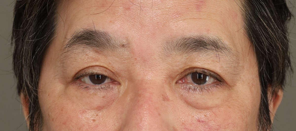 60代男性 右眼瞼下垂 術前 正面・開瞼（目元）