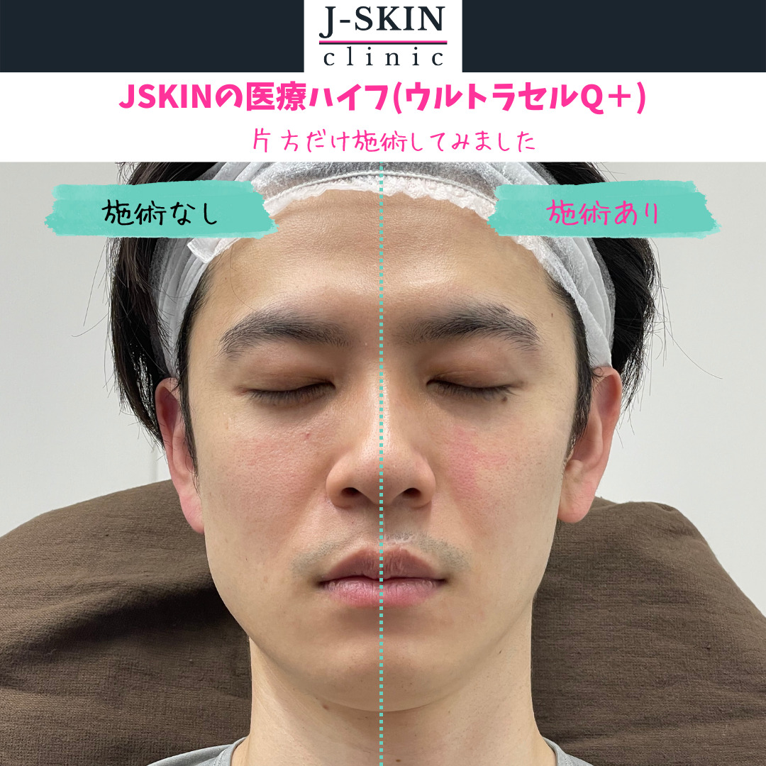 顔のたるみケア。ウルトラセルQプラスによる医療HIFU(ハイフ) - JSKINクリニック東京銀座｜あなたに応える美容医療