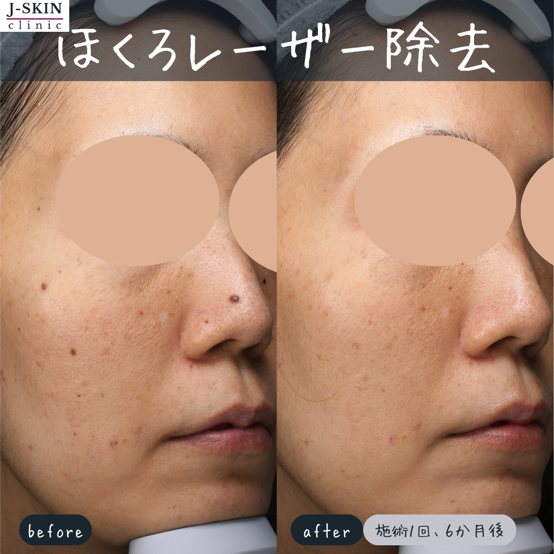 鼻・鼻横のほくろを丁寧にレーザー除去します - JSKINクリニック東京銀座|ほくろ・まぶた・肌の悩みに応える美容医療