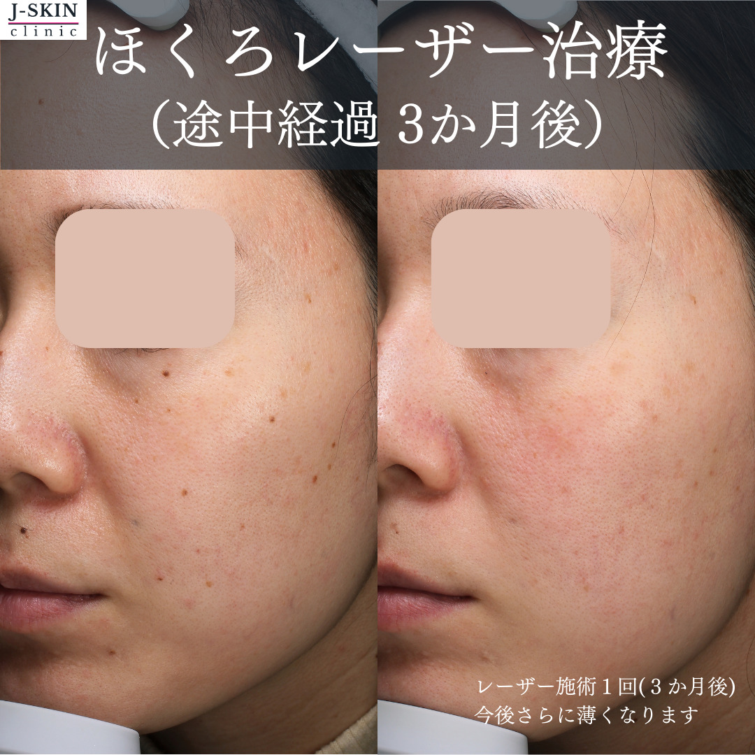 ほくろレーザー除去後の経過もサポートしています - JSKINクリニック