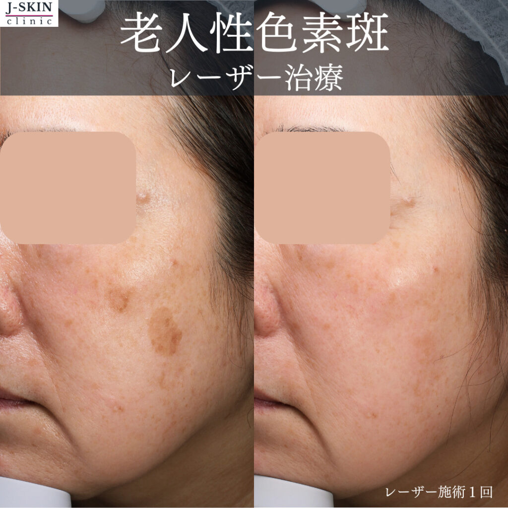 JSKINクリニックのシミ治療（総論） - JSKINクリニック東京銀座 