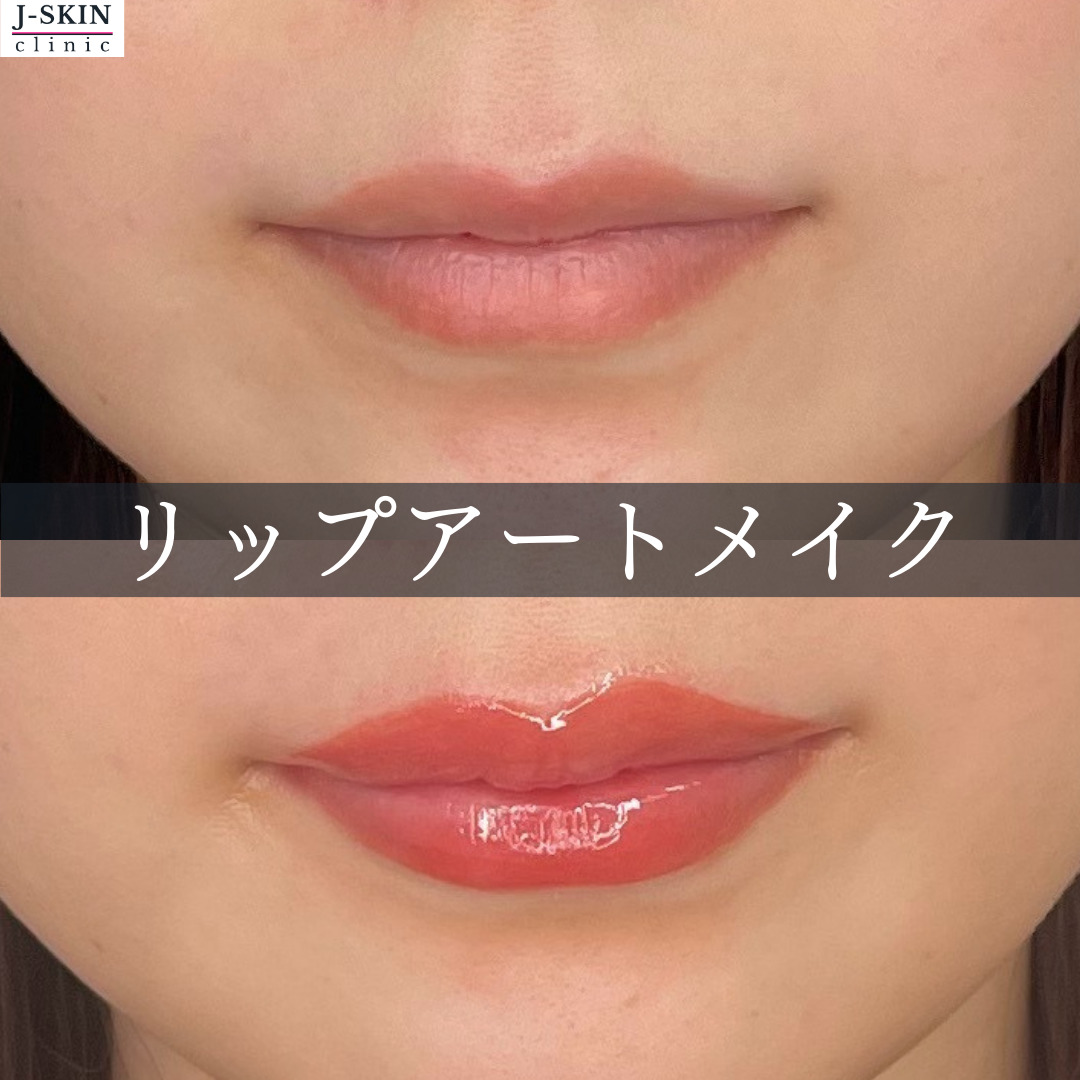 唇(リップ)のアートメイクも当院にお任せください - JSKIN