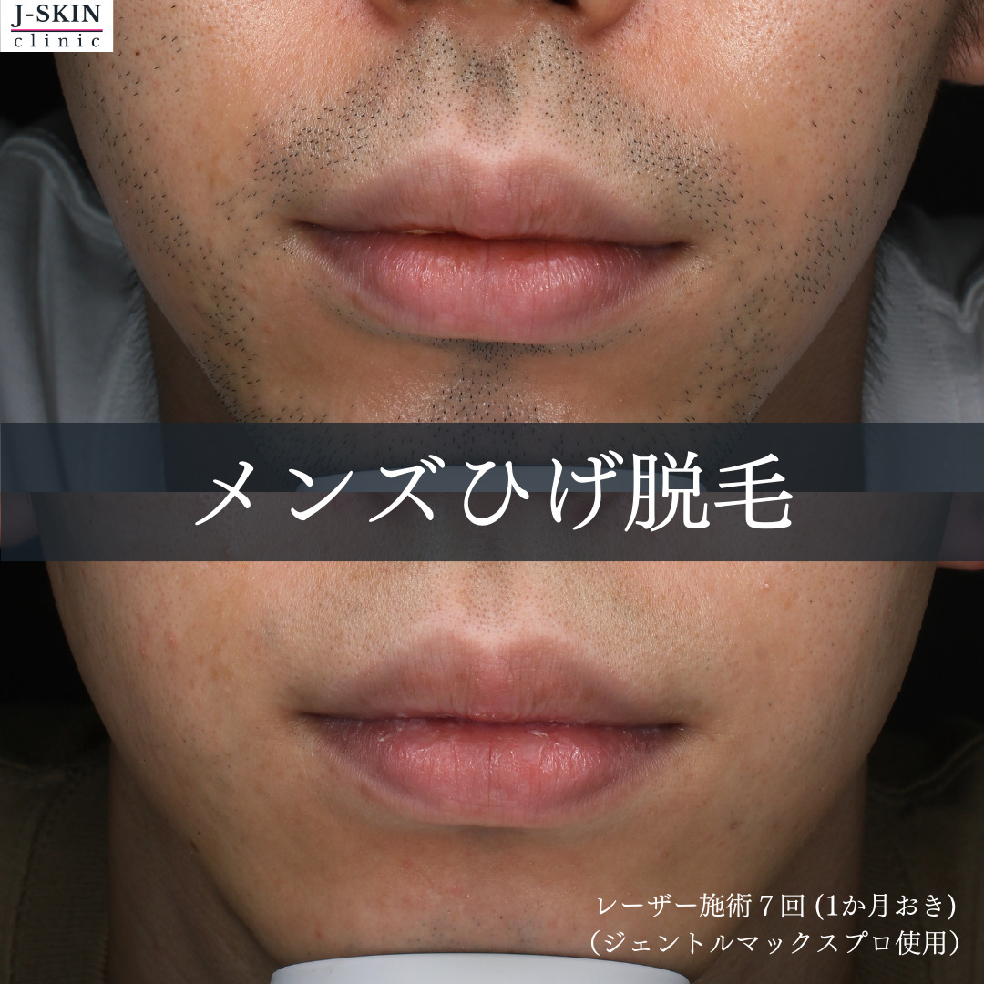 値段をおさえてメンズのヒゲ医療脱毛をご案内しています - JSKIN