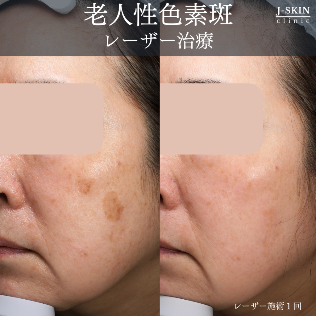 JSKINのくっきりしたシミ(老人性色素斑)治療 - JSKINクリニック東京 