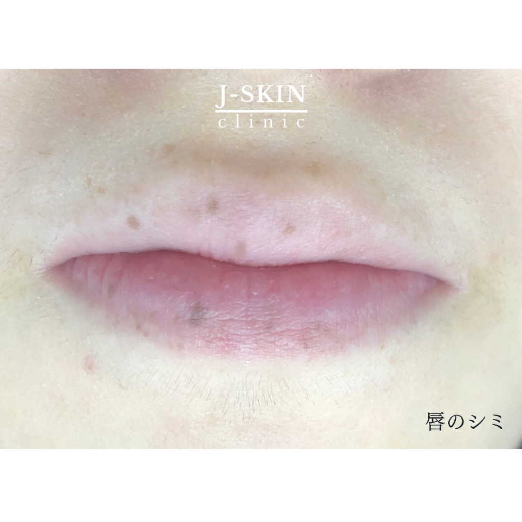 唇のシミの治し方について解説します - JSKINクリニック東京銀座  