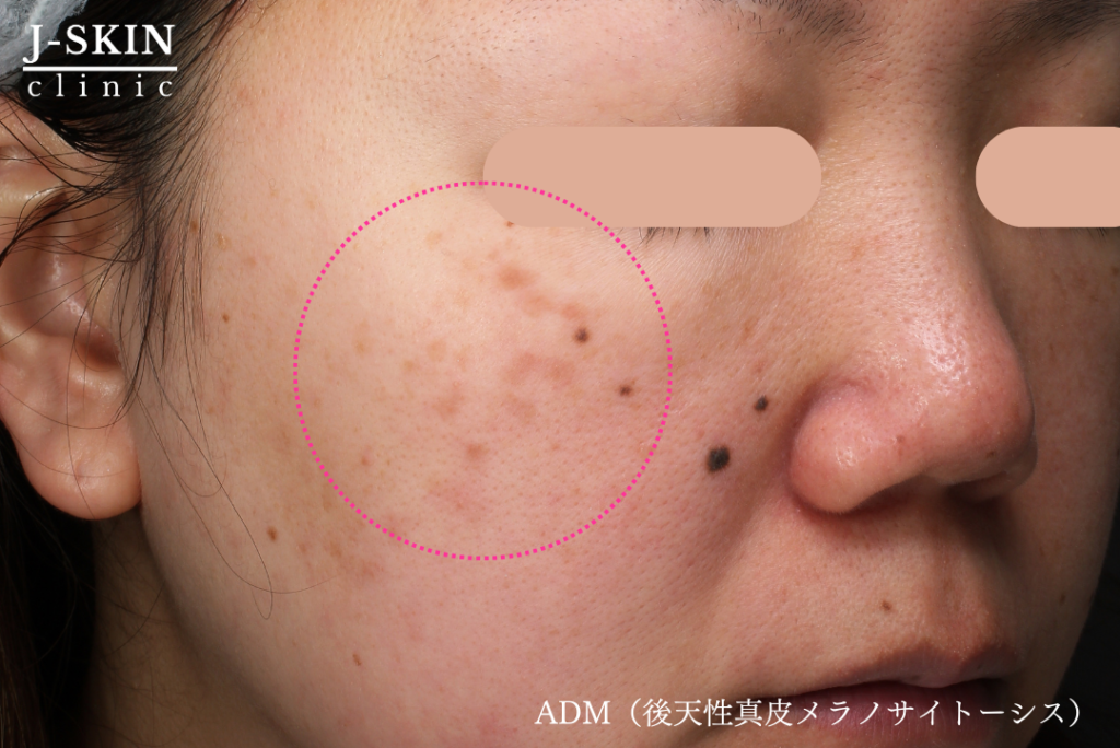 JSKINのADMレーザー治療(後天性真皮メラノサイトーシス) - JSKIN 