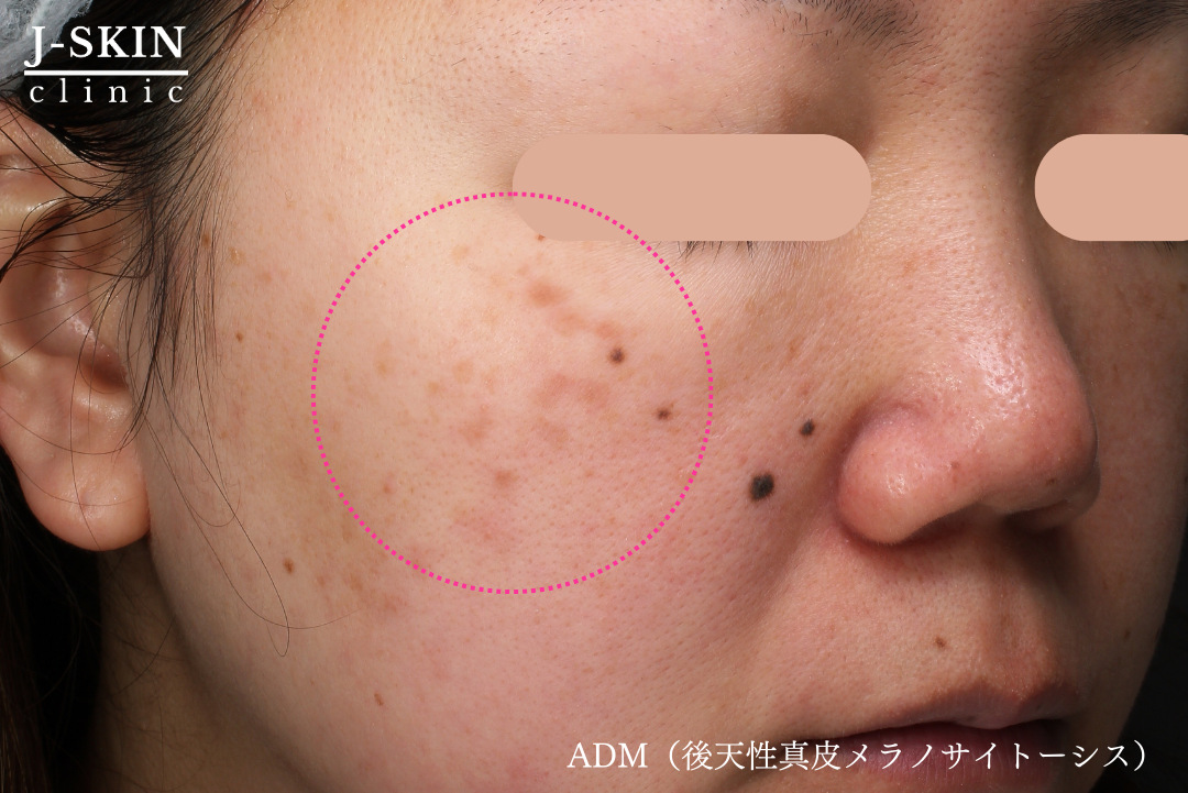 JSKINのADMレーザー治療(後天性真皮メラノサイトーシス) - JSKIN  
