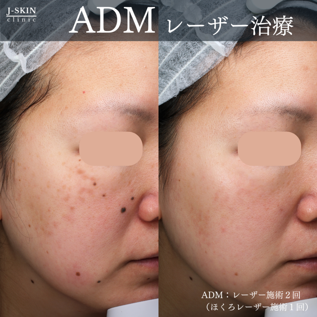 JSKINのADMレーザー治療(後天性真皮メラノサイトーシス) - JSKIN  