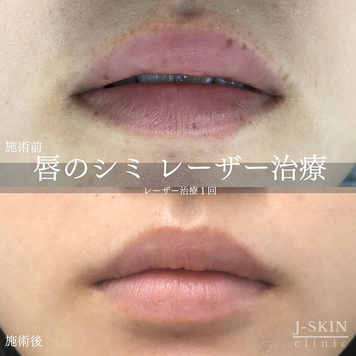 症例写真