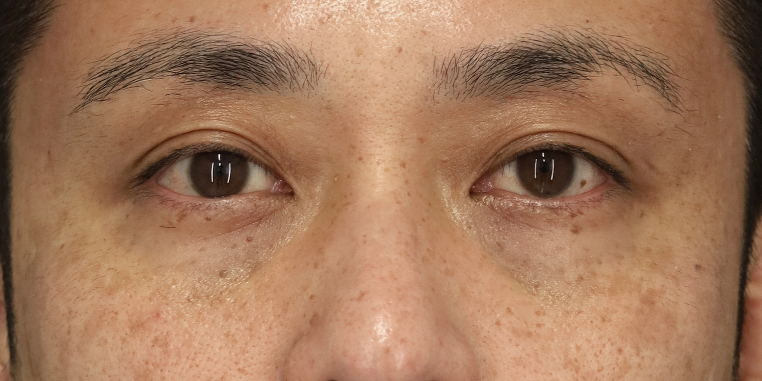 40代男性 目の下のクマ手術 術後6週間 正面（両目・目もと）