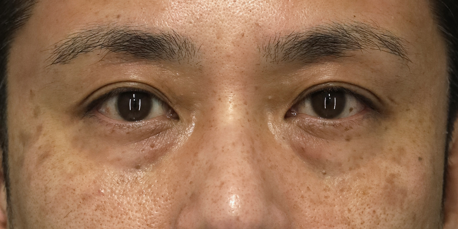 40代男性 目の下のクマ手術 術前 正面（両目・目もと）