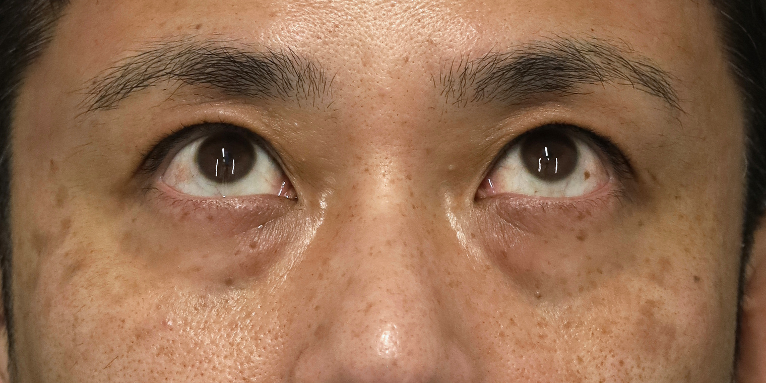 40代男性 目の下のクマ手術 術前（上を向いたとき） 正面（両目・目もと）