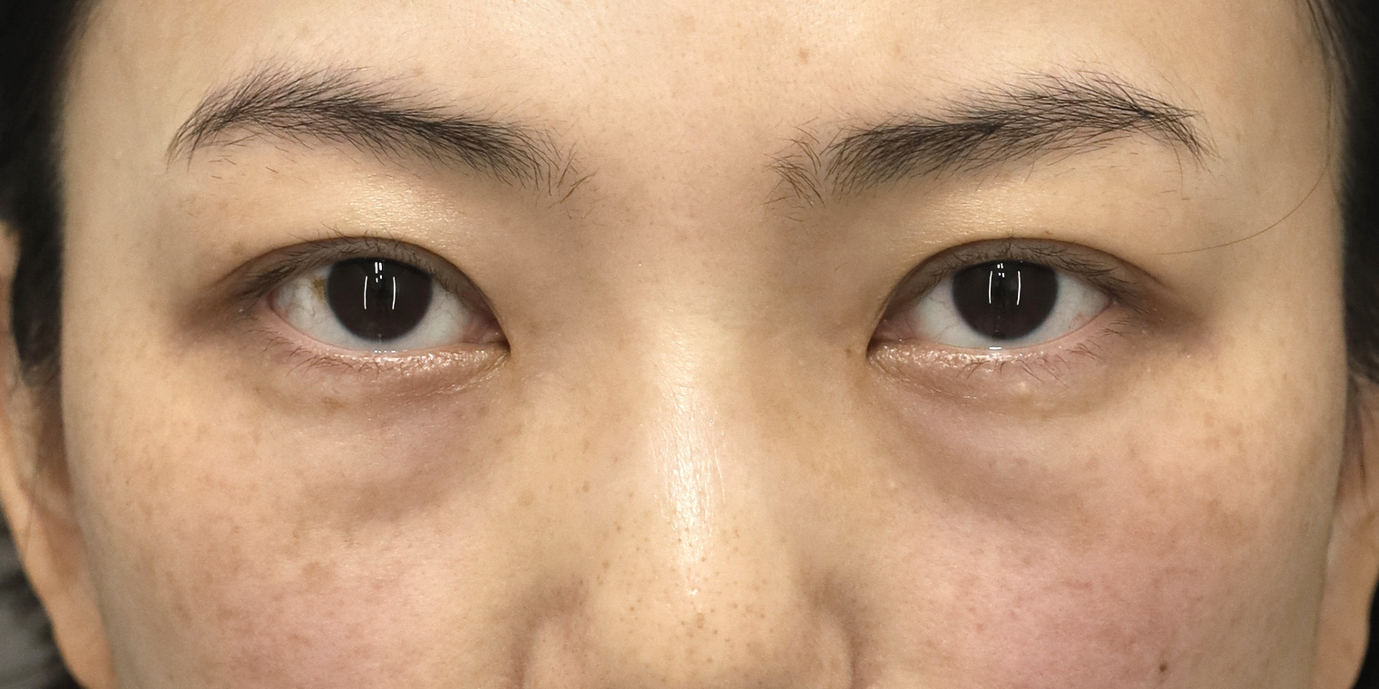 30代女性 目の下のクマ手術 術前 正面（両目・目もと）