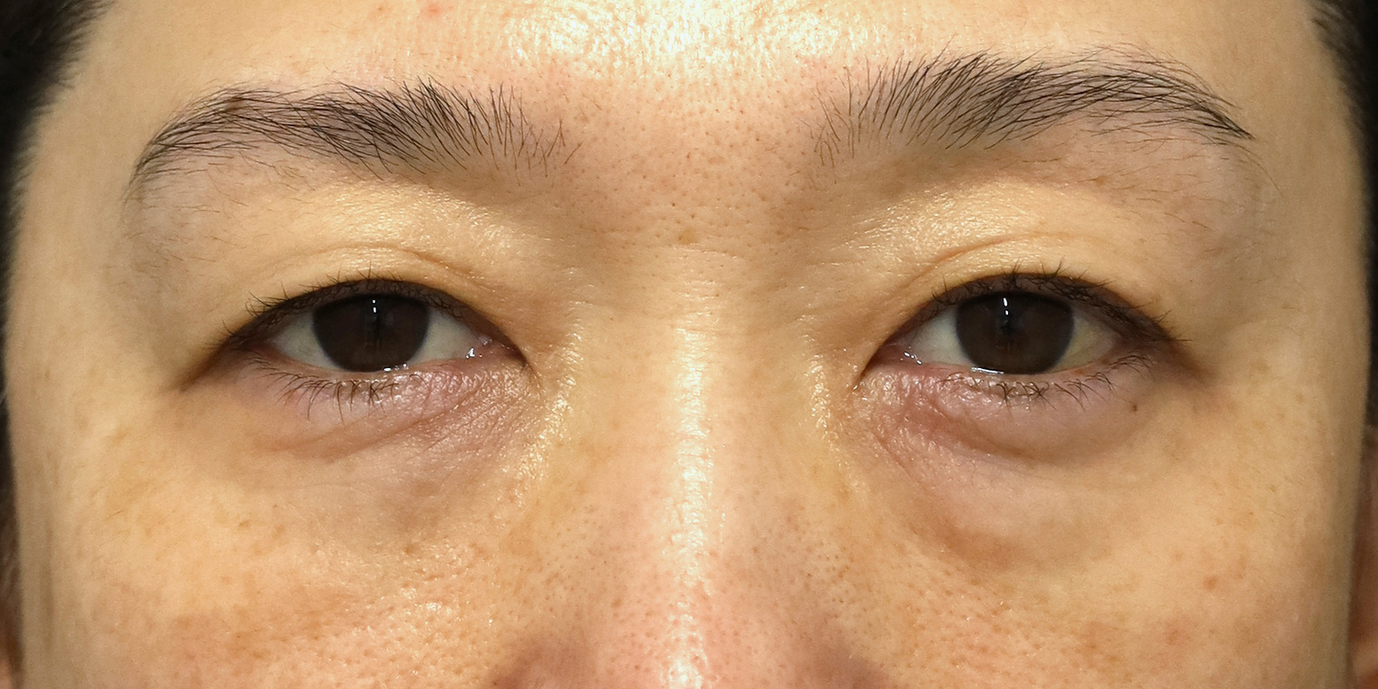 50代女性 目の下のクマ手術 術前 正面(両目・目もと)