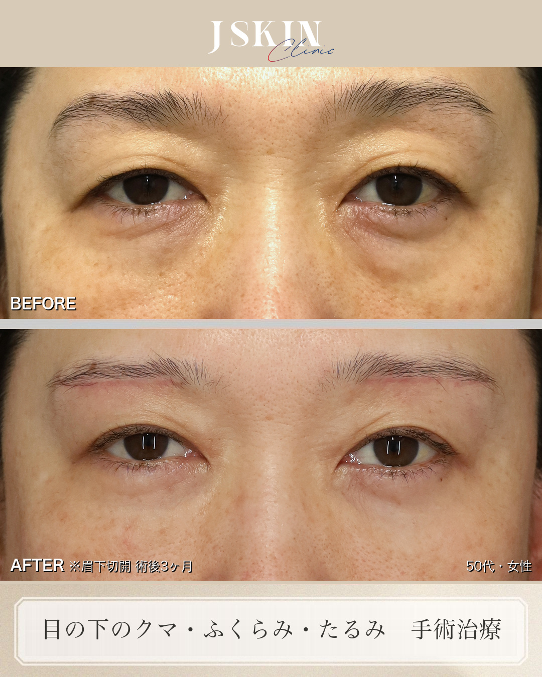 50代女性 目の下のクマ手術 術前・術後6ヶ月の比較