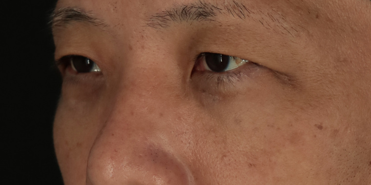 50代男性 目の下のクマ手術 術後2週間 斜め(目もと)