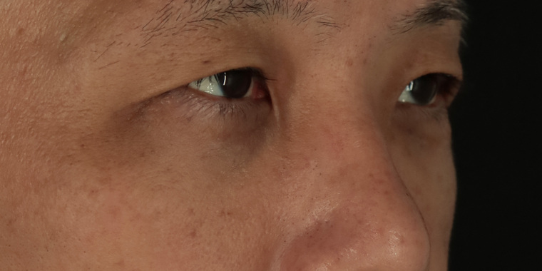 50代男性 目の下のクマ手術 術後2週間 斜め(目もと)