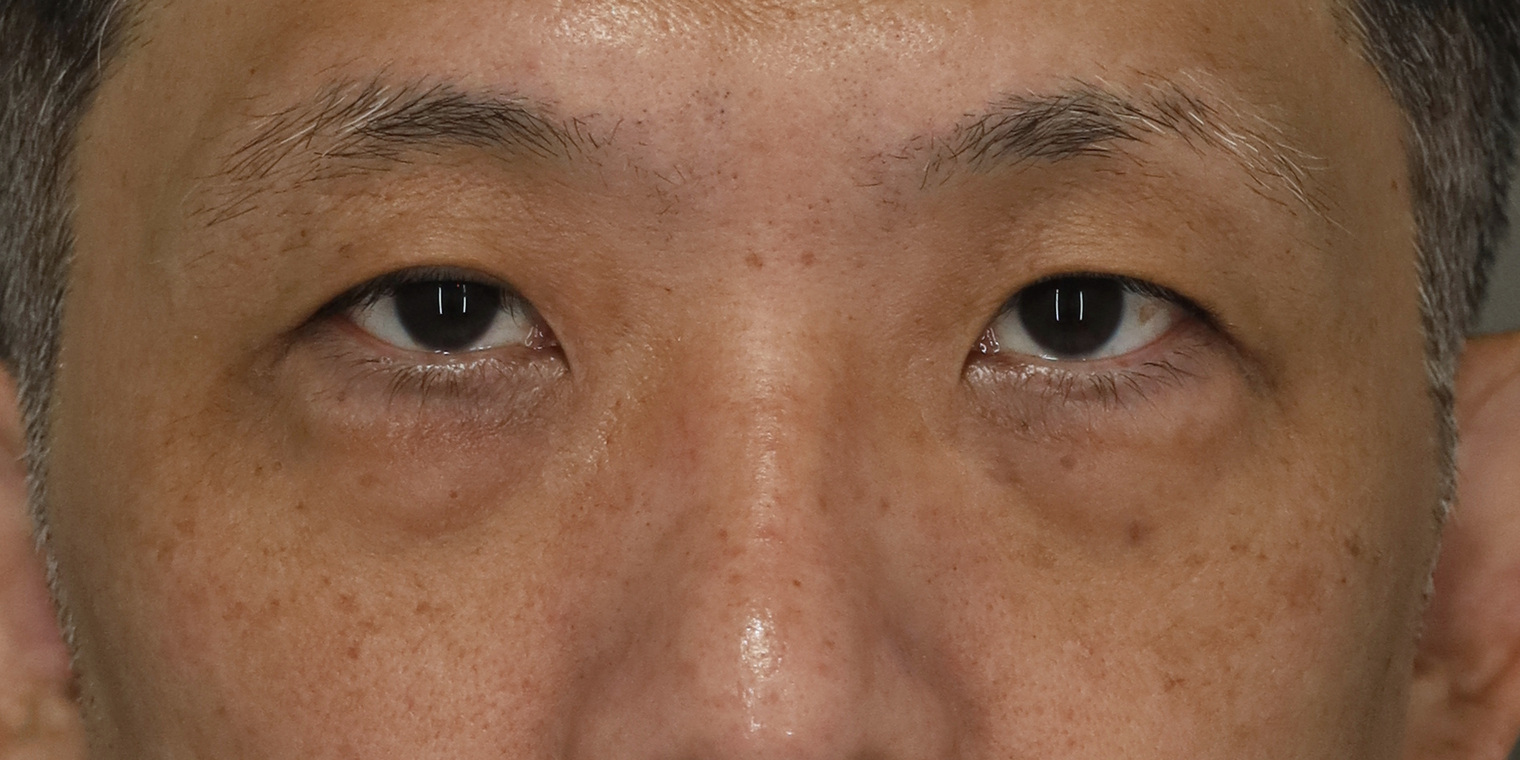 50代男性 目の下のクマ手術 術前 正面(両目・目もと)