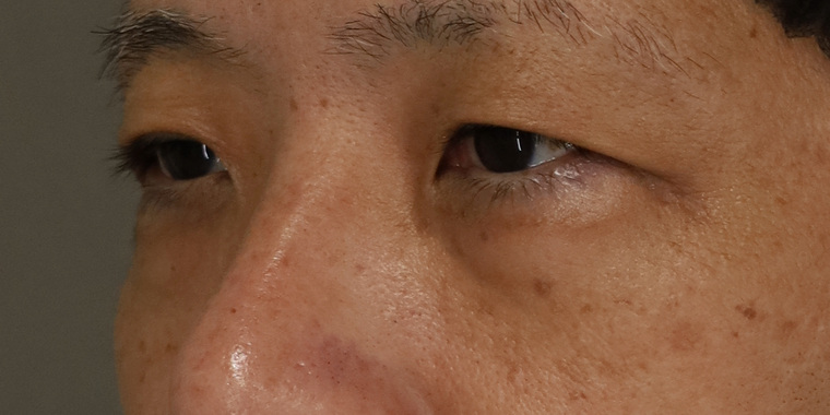 50代男性 目の下のクマ手術 術前 斜め(目もと)