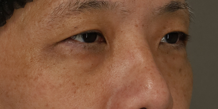50代男性 目の下のクマ手術 術前 斜め(目もと)