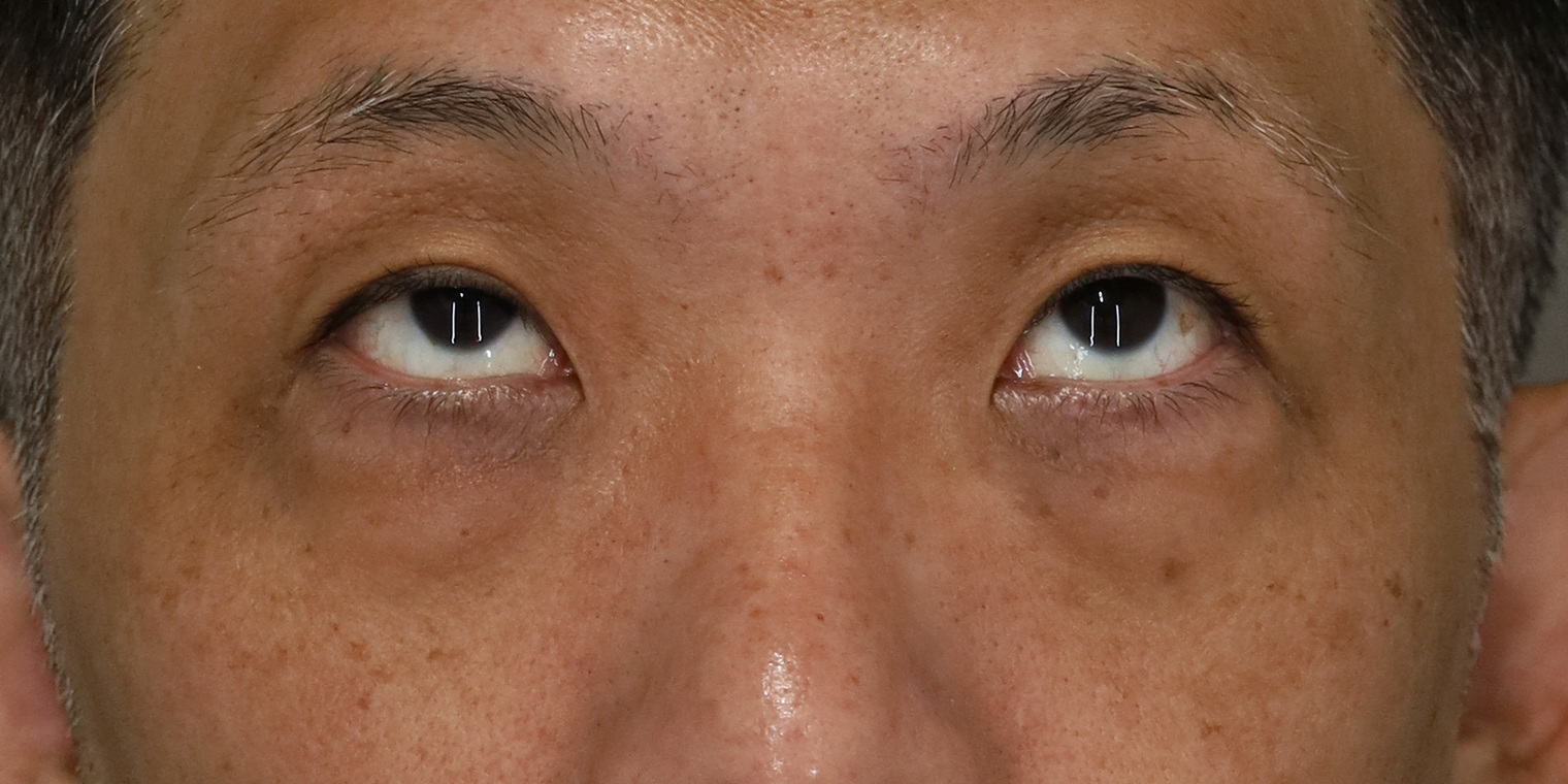 50代男性 目の下のクマ手術 術前(上を向いたとき) 正面(両目・目もと)