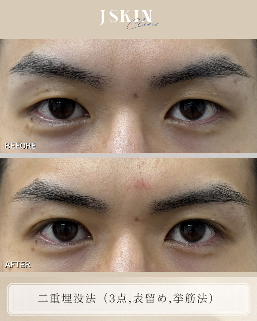 二重埋没法の症例 30代・男性／3点留め｜男性は、幅を出しすぎない