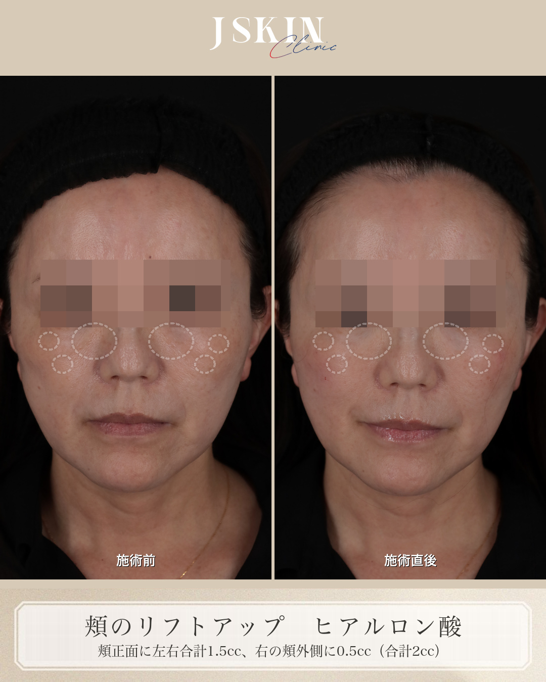 50代女性 頬 ヒアルロン酸 注入した部分(正面)