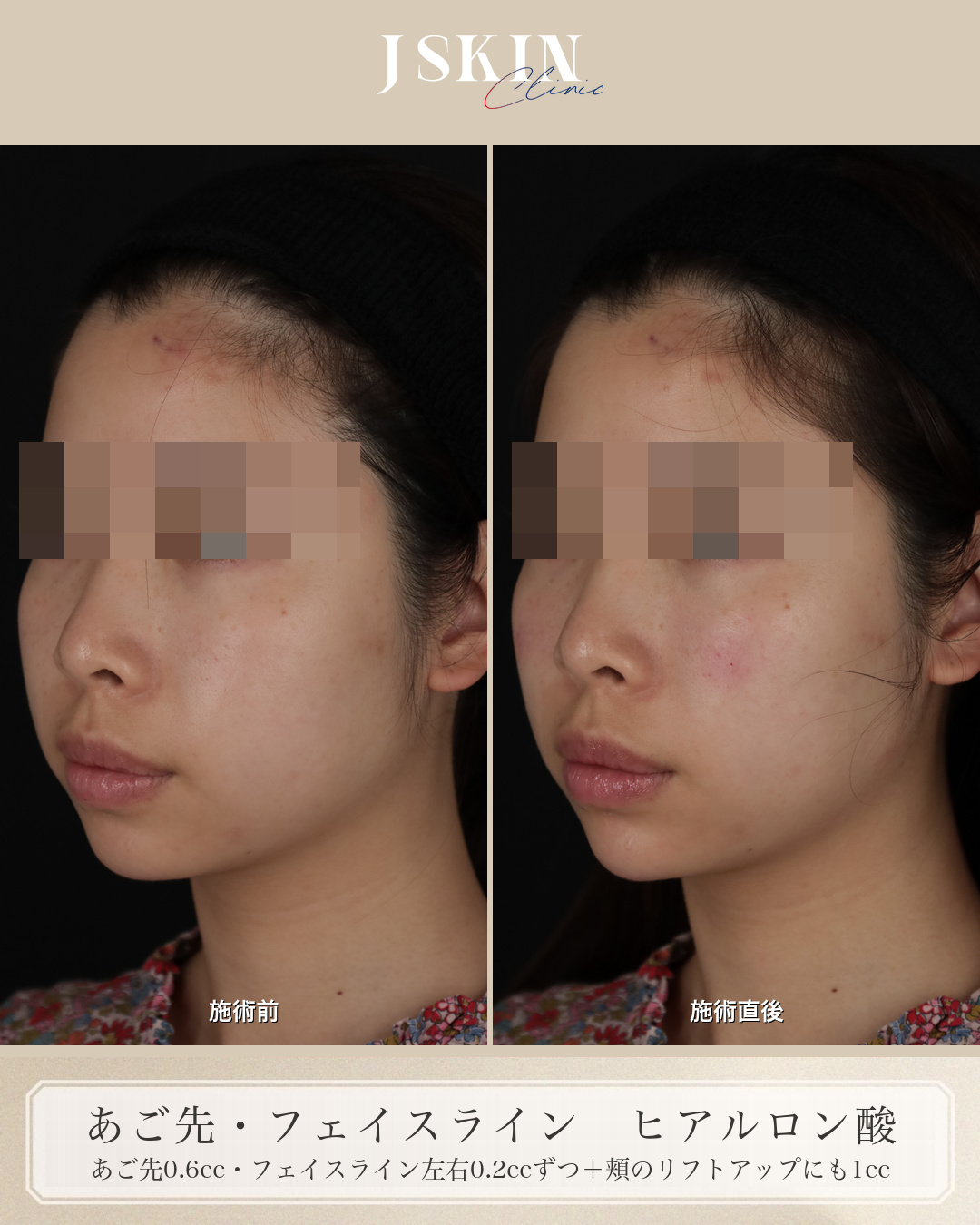 20代女性 あご先・フェイスライン ヒアルロン酸 施術前・施術直後の比較（左斜め）