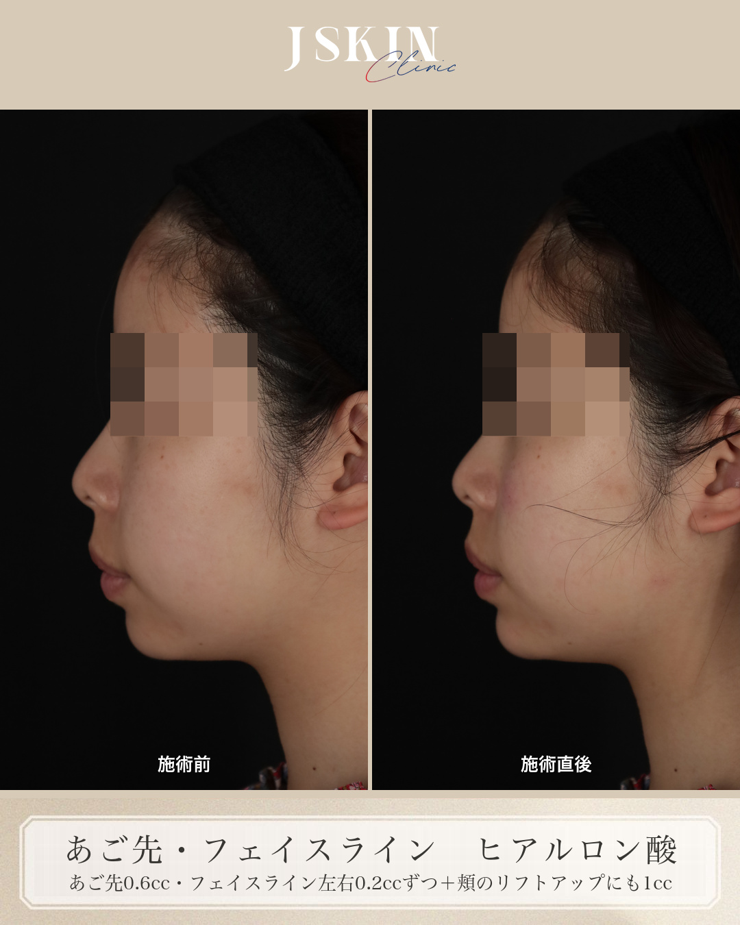 20代女性 あご先・フェイスライン ヒアルロン酸 施術前・施術直後の比較（左横）