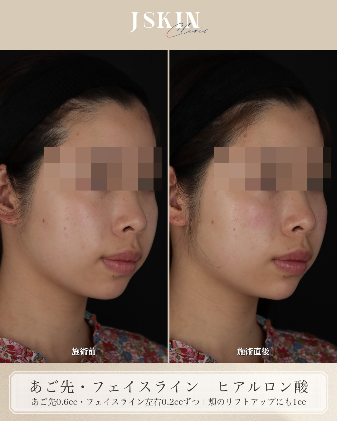 20代女性 あご先・フェイスライン ヒアルロン酸 施術前・施術直後の比較（右斜め）