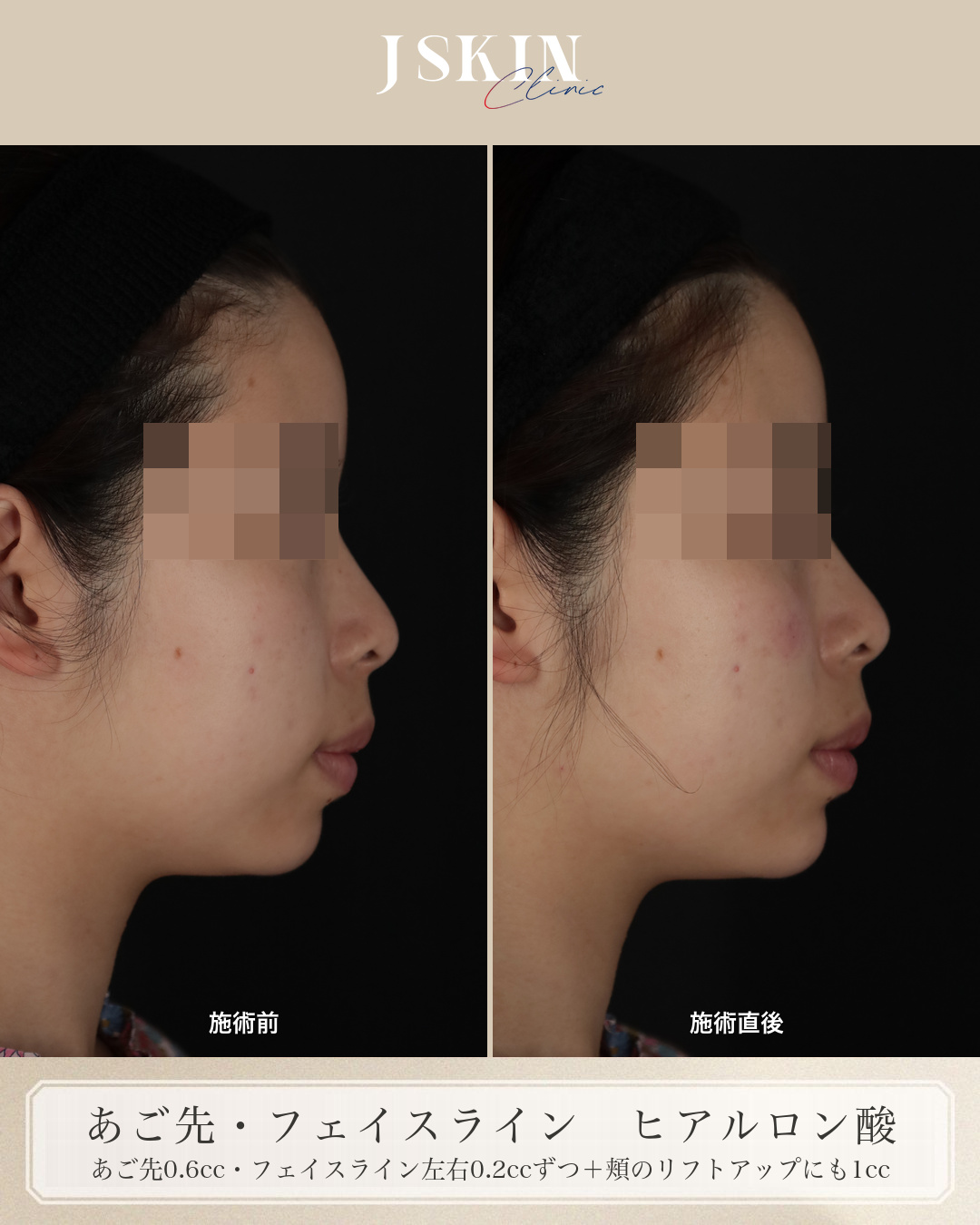 20代女性 あご先・フェイスライン ヒアルロン酸 施術前・施術直後の比較（右横）