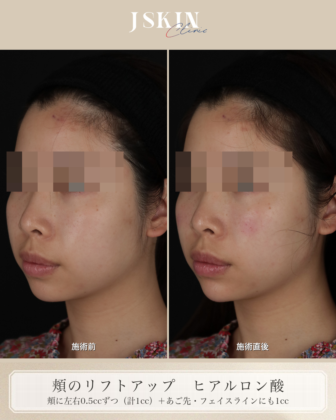 20代女性 頬 ヒアルロン酸 施術前・施術直後の比較（左斜め）
