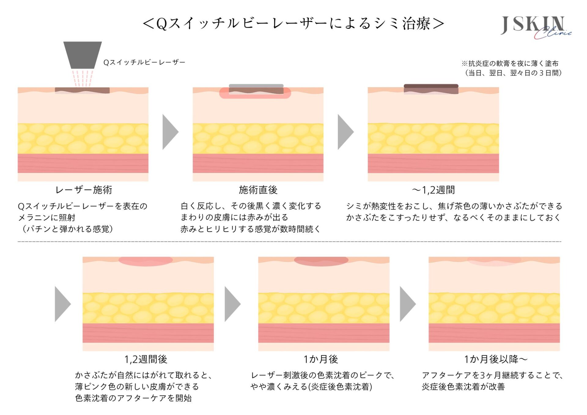 顔のシミ・ルビーレーザー治療後のケア - JSKINクリニック東京銀座