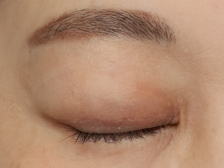 50代女性 眼瞼下垂 術後2ヶ月 右目・閉瞼