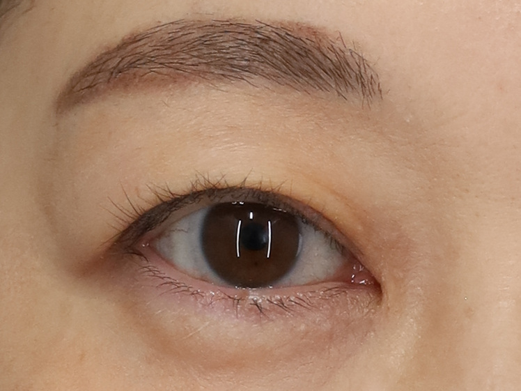50代女性 眼瞼下垂 術後2ヶ月 右目・開瞼