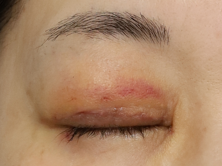 50代女性 眼瞼下垂 術後1週間（抜糸） 右目・閉瞼