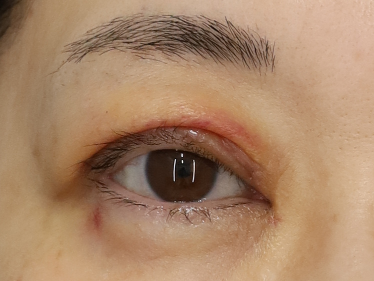 50代女性 眼瞼下垂 術後1週間（抜糸） 右目・開瞼