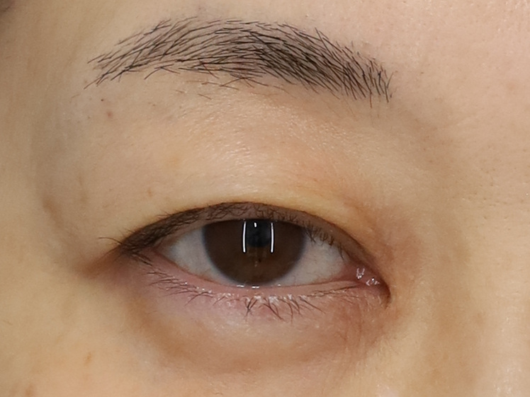 50代女性 眼瞼下垂 術前 右目・開瞼