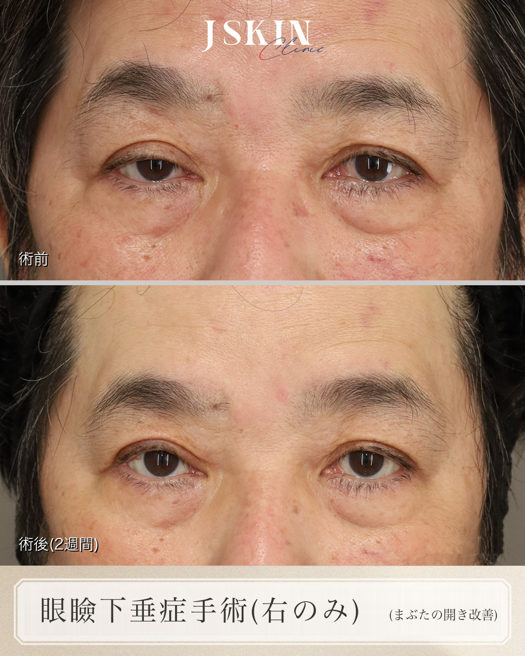 60代男性 眼瞼下垂 術前・2週間後の比較