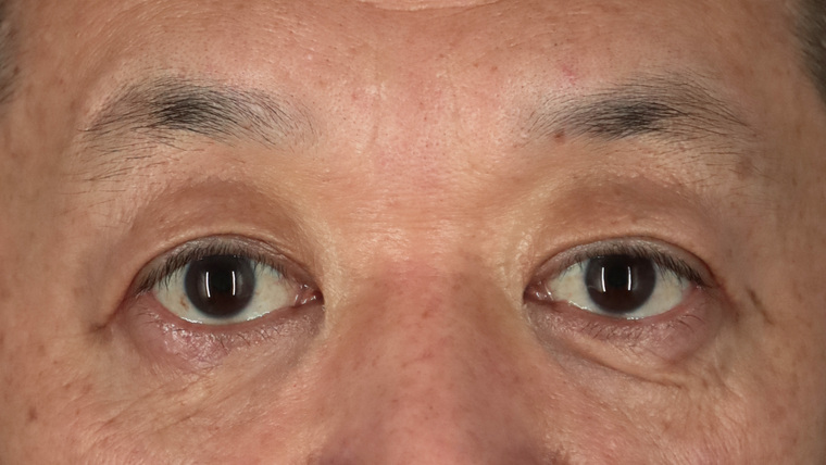 60代男性 眼瞼下垂 術後2ヶ月 正面・開瞼（両目・目もと）
