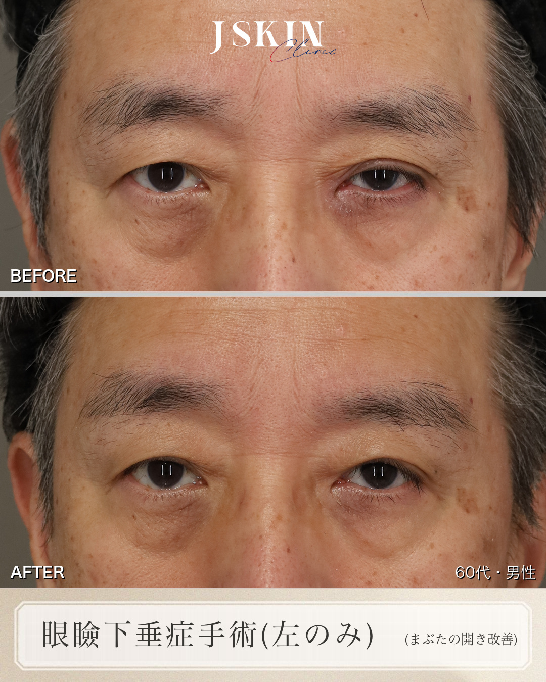 緑内障の目薬で、片方のまぶたが下がっていた眼瞼下垂 術前・術後2ヶ月の比較