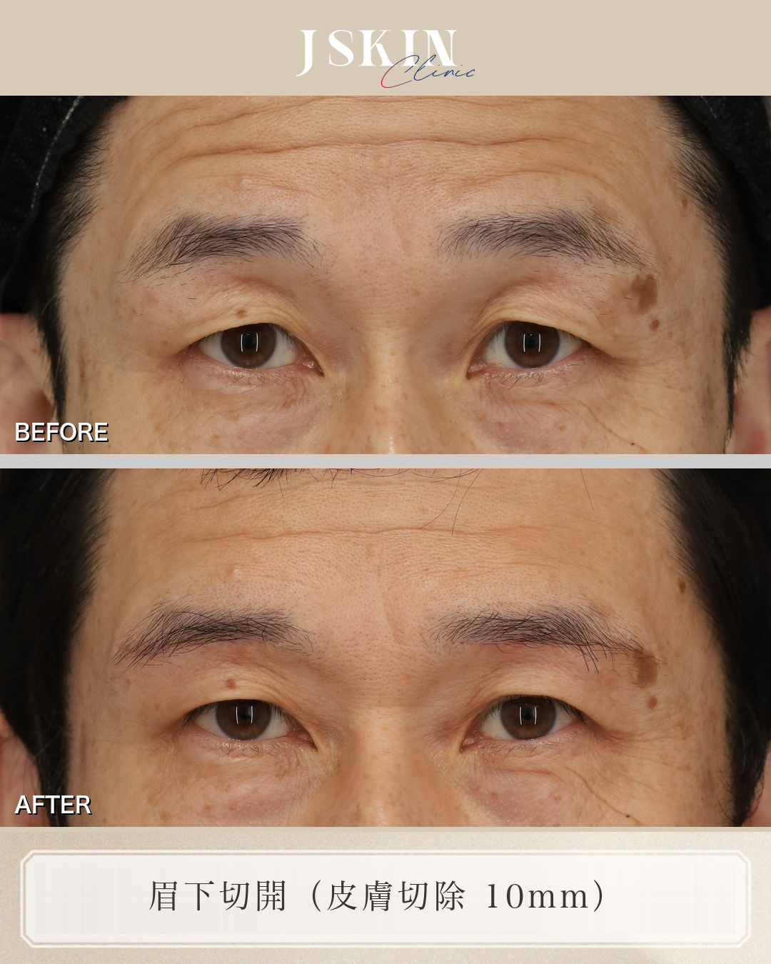 50代男性 眉下切開 術前・術後3ヶ月の比較
