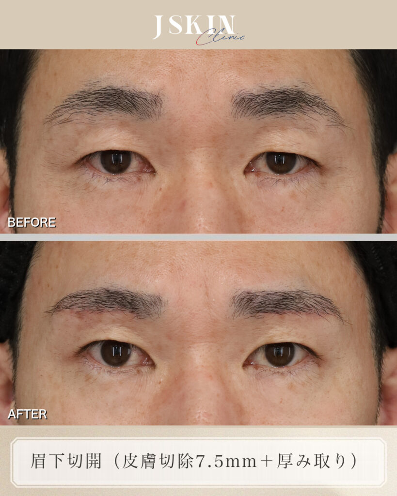 眉下切開の症例 50代・男性／両側・自費診療（厚み取り併用）｜皮膚を取るだけでは足りないまぶた