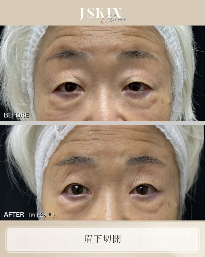 まぶたの重さは取りたい、でも二重にはしたくない。眉下切開（皮膚切除10mm）で改善した症例