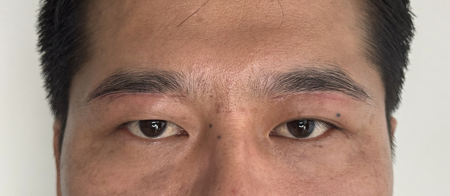 40代男性 眉下切開 術後3ヶ月 正面・開瞼(両目・目もと)