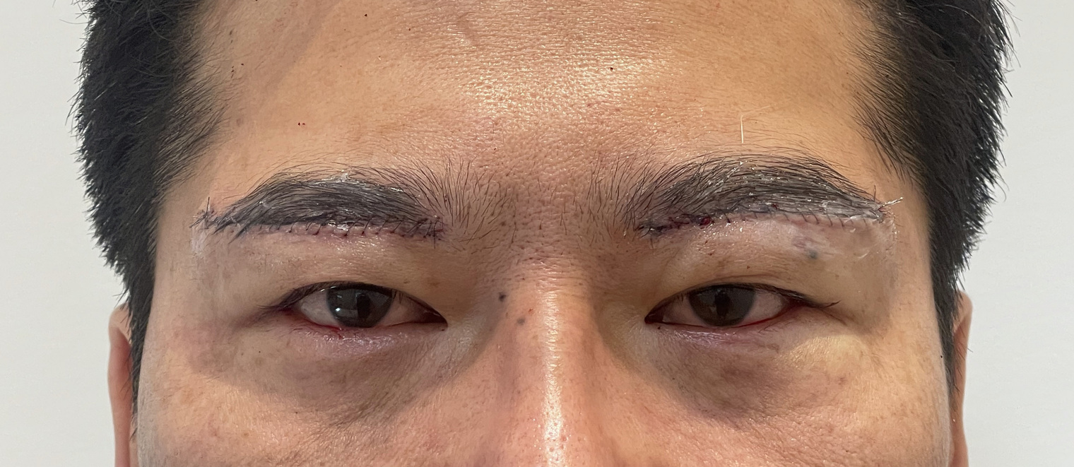 40代男性 眉下切開 術直後 眉毛の下縁に沿った縫合線