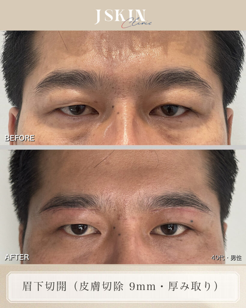 「目つきは変えずに、かぶさりを軽くしたい」に応えた眉下切開（皮膚切除9mm）の症例