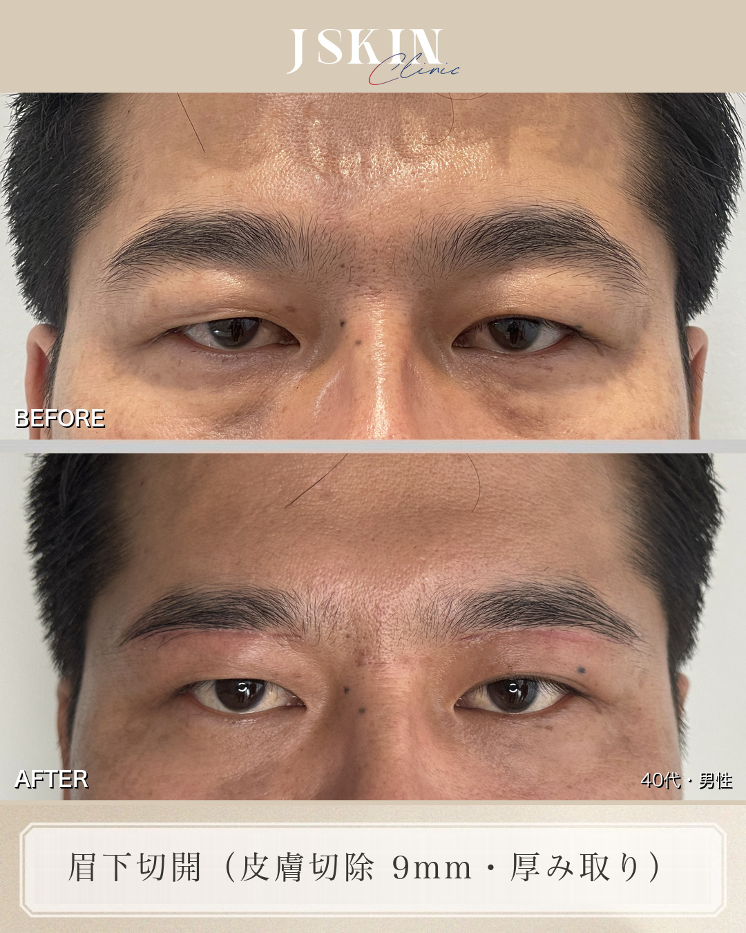 40代男性 眉下切開 術前・術後3ヶ月の比較