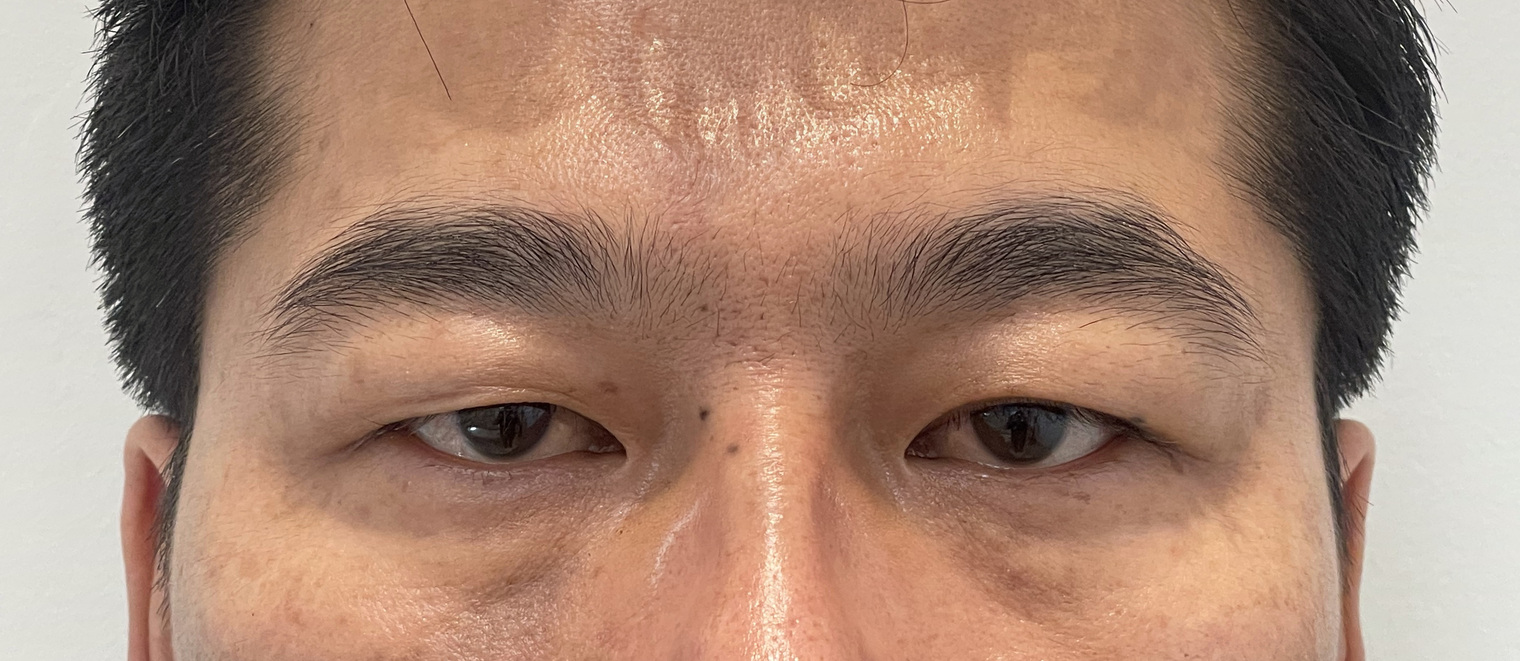 40代男性 眉下切開 術前 正面・開瞼(両目・目もと)